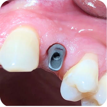 Implantációs fogpótlás