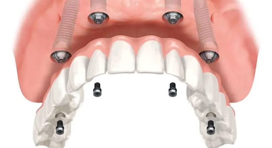 Miniimplantátumos fogsorrögzítés
