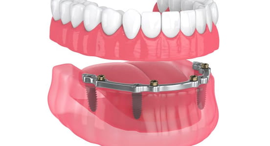 Stéges fogsor / Overdenture