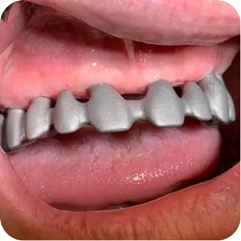 Stéges fogsor / Overdenture