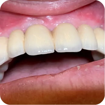 Stéges fogsor / Overdenture